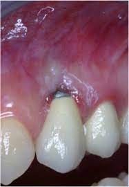 Course Image PATOLOGIAS PERIIMPLANTARIAS