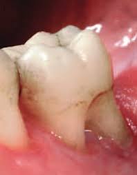 Course Image MANEJO Y FUNDAMENTOS DE TEJIDOS PERIODONTALES PARA EL EXITO DE LA REHABILITACION ORAL