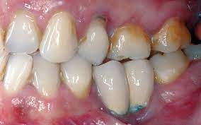Course Image PATOLOGIAS PERIIMPLANTARIAS