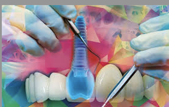 Course Image REVISION DE LITERATURA DE IMPLANTES TENDENCIAS ACTUALES